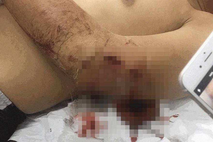 Anh C. bị "cắt tặc" chém trọng thương. Ảnh: V.D