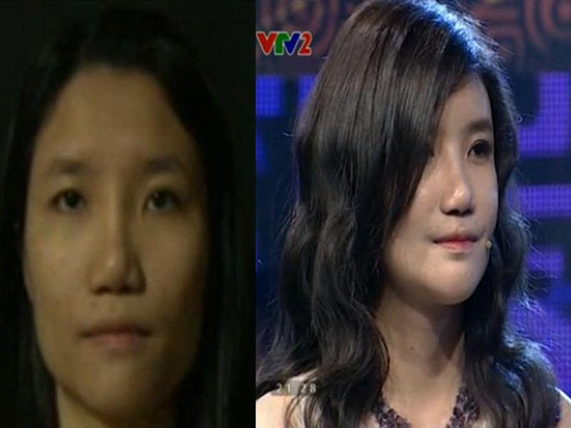 Thúy Ngân trước và sau khi phẫu thuật thẩm mỹ.