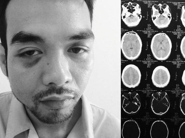 Đường Quang Anh đã bị một nhóm côn đồ dùng gậy chơi bi–a vụt khiến khuôn mặt bị biến dạng