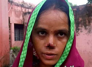 Chồng cắt mũi vợ vì không ‘cống nộp’ đủ tiền hồi môn