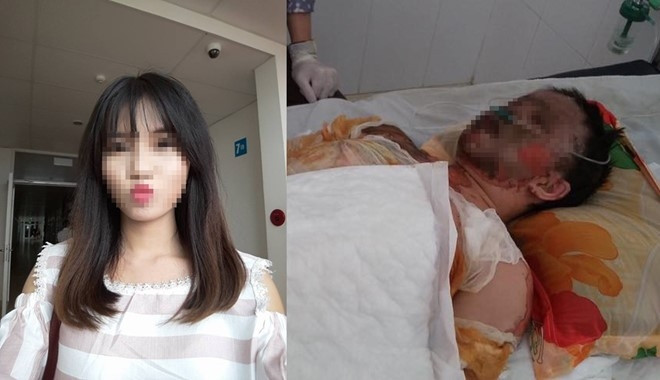 Sau vụ tai nạn Hằng bị bỏng toàn thân, khuôn mặt biến dạng và hai tay cháy khô