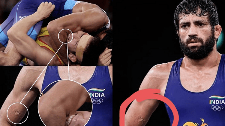 Vết cắn của Nurislam Sanayev hằn sâu trên cánh tay của Ravi Dahiya