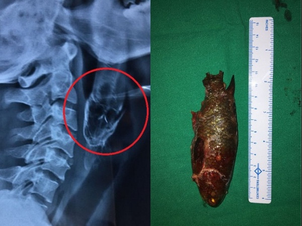 Phần đầu con cá dài hơn 11cm chui xuống họng Dash. Ảnh: Mirror