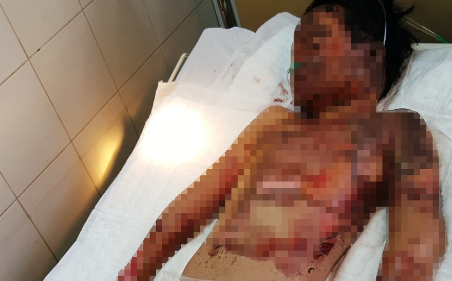 Dùng xăng nướng khoai, học sinh lớp 5 này hiện nguy kịch tính mạng do bỏng nặng.