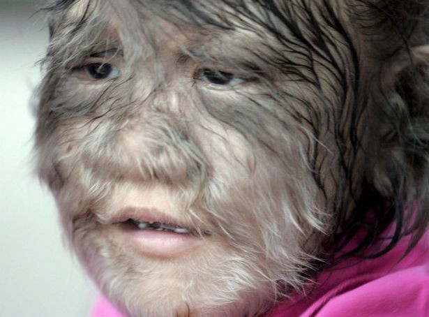 Một em nhỏ mắc hội chứng "người sói". Ảnh minh hoạ: EPA