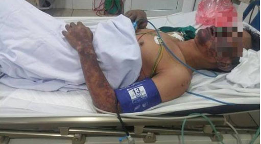 Bệnh nhân bị ban hoại tử chủ yếu ở mặt và các chi