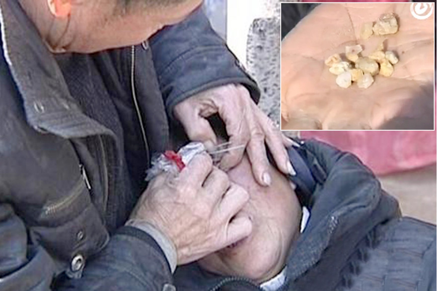 Ông Liang dùng que sắt khều đá từ trong mắt vợ.