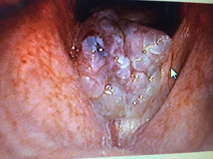 Nữ sinh 23 tuổi cắt u nhú thanh quản 22 lần 