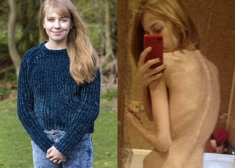 Cô gái trẻ 'điên cuồng' giảm cân để giống thần tượng