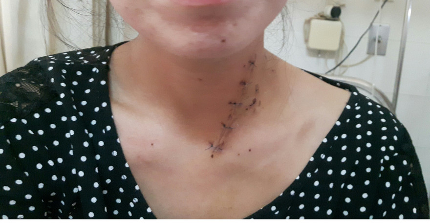 Bệnh nhân Đặng Thị H. hồi phục tốt sức khỏe sau mổ.