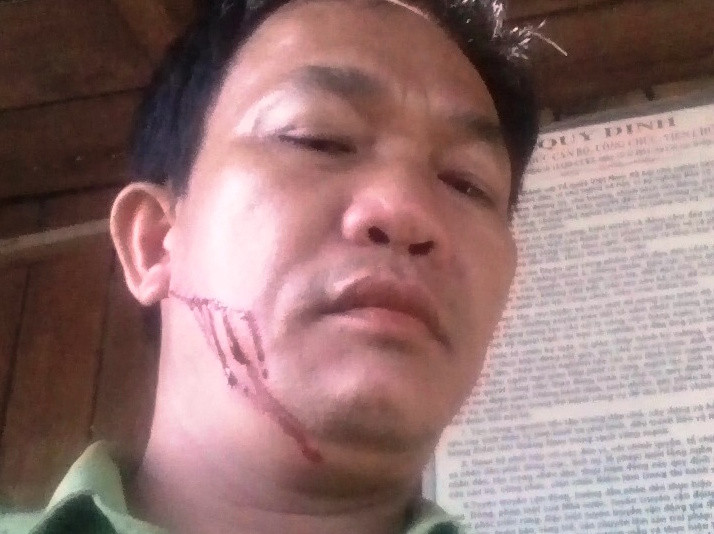 Kiểm lâm viên Nguyễn Thà bị chém rách mặt