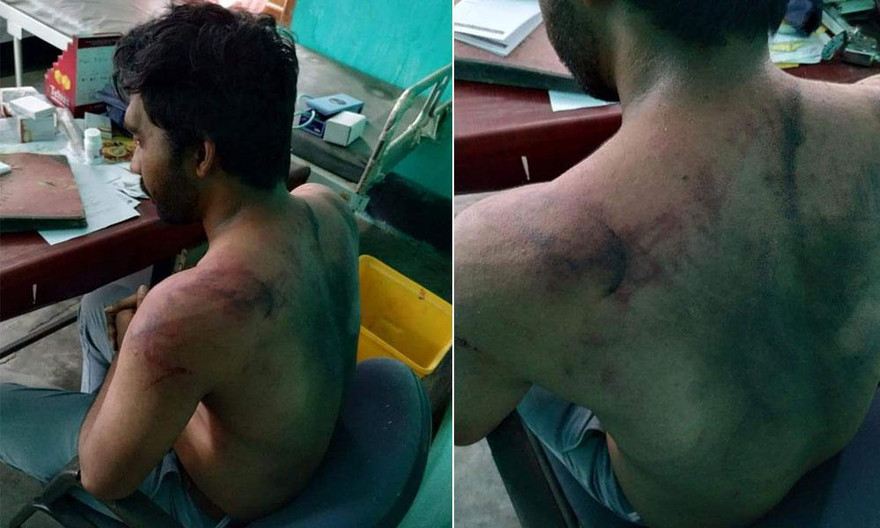 Bác sĩ Senapati bầm tím khắp người sau vụ hành hung. Ảnh: Twitter