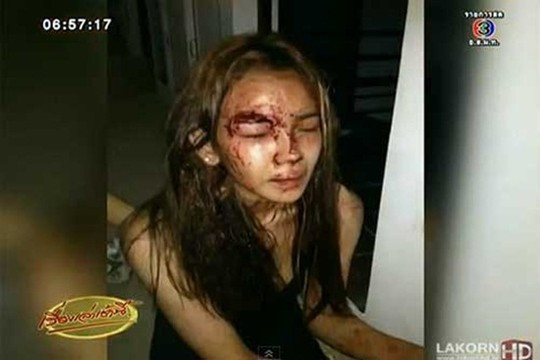 Nữ ca sĩ bị thương tích sau vụ đột nhập. Ảnh: Lakorn.