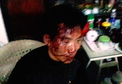 Anh Hoàn bị nhóm côn đồ dùng dao đánh vào trán. Ảnh: TL.