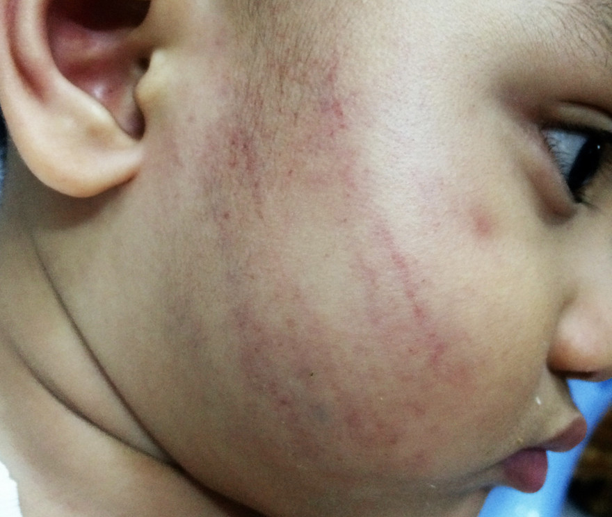 Mặt cháu Huy sau khi bị cô Quý tát 