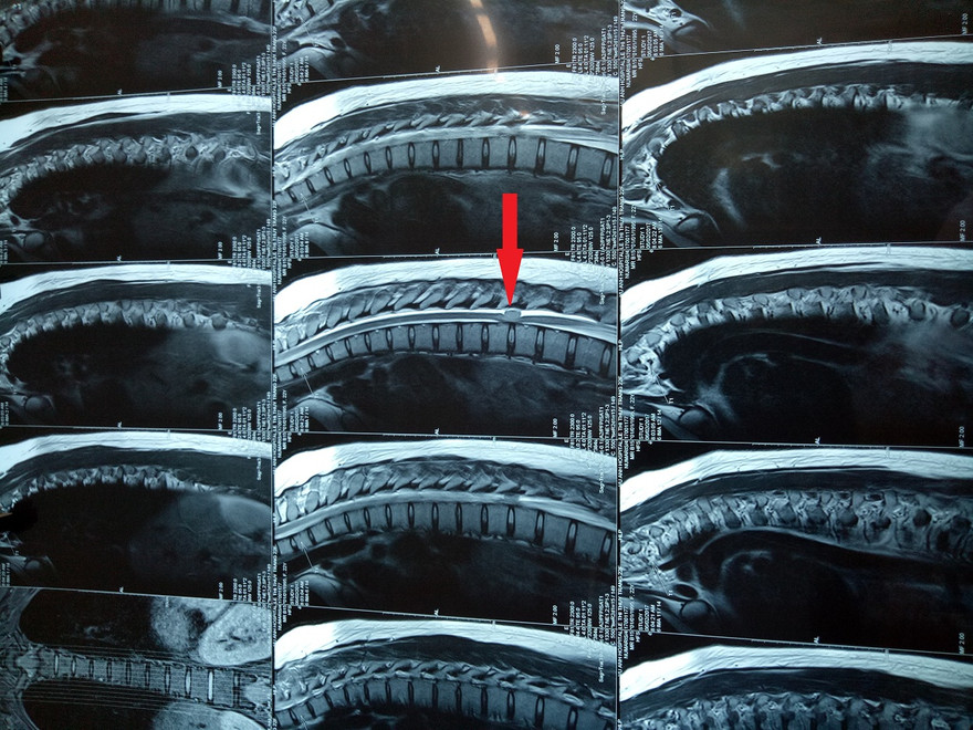 Hình ảnh chụp MRI khối u trước phẫu thuật.