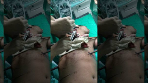 Pal bị hai thanh sắt đâm xuyên cơ thể sau cú ngã tại công trường xây dựng. Ảnh: Newslion.