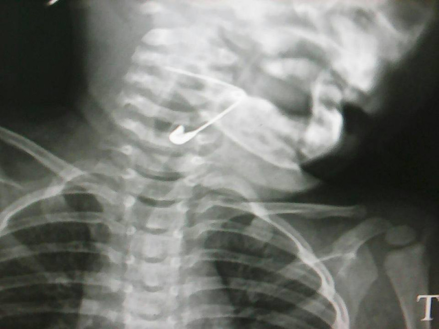 Cây kim băng được phát hiện trong thanh quản cháu bé trong tư thế mở