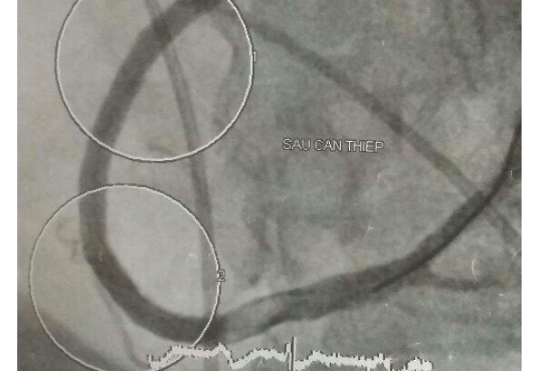 Ảnh chụp cắt lớp sọ não thì phát hiện bệnh nhân K bị nhồi máu não và xuất huyết não đồng thời. Ảnh: Xuân Chi