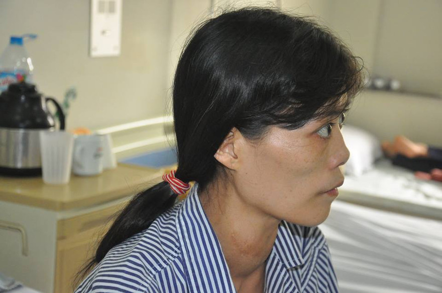 Suýt chết vì điều trị bệnh Basedow bằng thuốc nam