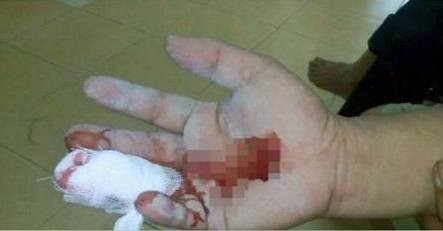 Vết thương trên tay của nam thanh niên.