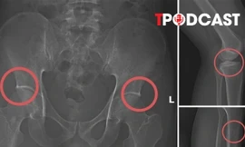 NÓNG 28/11: Vụ dùng búa đục xương để trục lợi bảo hiểm: Hé mở thủ đoạn của Tạ Minh Châu