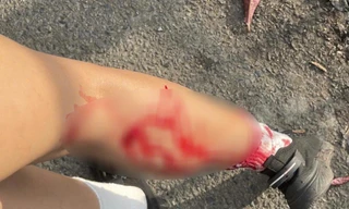 Khỉ hoang tấn công gây thương tích cho người dân ở Vũng Tàu