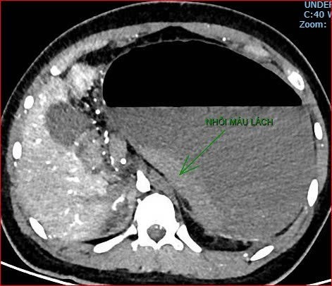 H&igrave;nh ảnh nội soi cho thấy t&igrave;nh trạng vi&ecirc;m tụy cấp