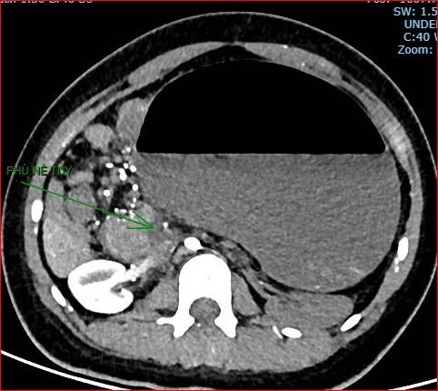 H&igrave;nh ảnh CT cho thấy t&igrave;nh trạng xoắn dạ d&agrave;y v&agrave; nhồi m&aacute;u nội tạng