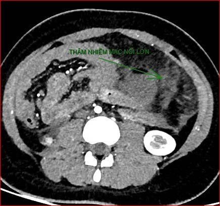 CT cắt lớp vi t&iacute;nh hiển thị mức độ nghi&ecirc;m trọng của bệnh