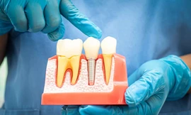 Bí quyết lựa chọn trụ implant phù hợp khi trồng răng