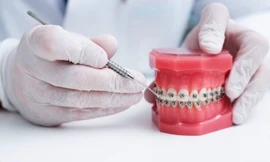 Top 4 lý do bạn nên chọn niềng răng mắc cài kim loại