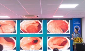 Viêm loét đại tràng trị hoài không khỏi, vì sao cần nội soi và sinh thiết chuẩn? 