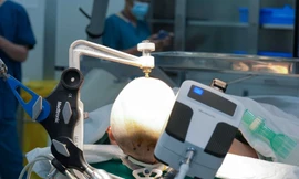 Vinmec tiên phong điều trị động kinh bằng Robot định vị thần kinh hàng đầu thế giới