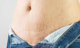 Tại sao rạn da không dễ cải thiện - Đâu là cơ chế phục hồi cần nhắm đến?