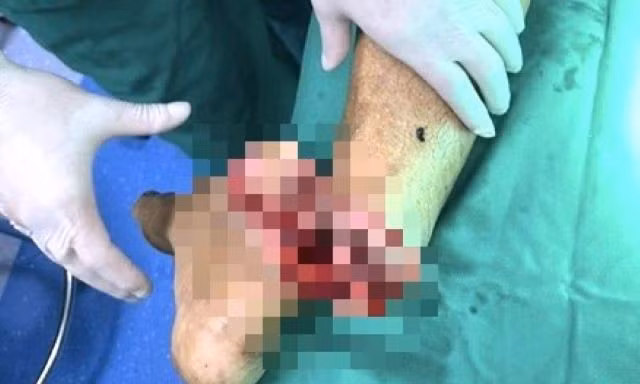 Bị chém gần đứt lìa chân khi mang hung khí đi tìm đối thủ