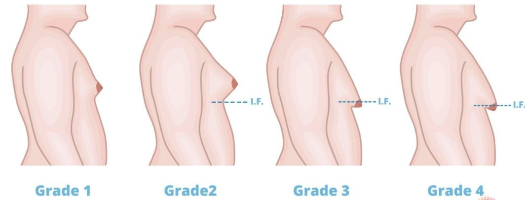Dựa trên đặc điểm hình thái tuyến vú trên siêu âm, phân loại của Rohrich: Độ 1: phì đại tối thiểu <250g, không có sa trễ; Độ 2: phì đại vừa 250-500g, không có sa trễ; Độ 3: phì đại nặng >500g, sa trễ độ 1; Độ 4: phì đại nặng kèm sa trễ độ 2 hoặc 3. Dựa trên đặc điểm hình thái tuyến vú trên siêu âm, phân loại của Rohrich: Độ 1: phì đại tối thiểu <250g, không có sa trễ; Độ 2: phì đại vừa 250-500g, không có sa trễ; Độ 3: phì đại nặng >500g, sa trễ độ 1; Độ 4: phì đại nặng kèm sa trễ độ 2 hoặc 3.