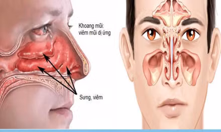 Đừng nhầm viêm mũi dị ứng với viêm xoang: Tự dùng thuốc có thể khiến bệnh nặng hơn