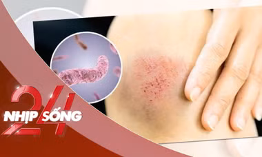 NHỊP SỐNG 24: 23 người ở Thái Lan tử vong do bệnh ‘sốt đất’ , Bộ Y tế Việt Nam ra khuyến cáo