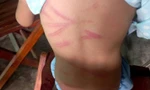Bé gái 6 tuổi bị mẹ đánh nhiều lần gây thương tích