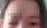  Thiếu nữ mù mắt, nhập viện cấp cứu vì tiêm filler thẩm mỹ ở tiệm cắt tóc, gội đầu