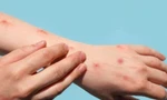 Bến Tre ghi nhận ca đậu mùa khỉ đầu tiên, bệnh nhân tiếp xúc với nhiều người 