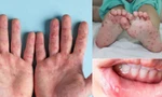 Tiếp xúc với bệnh nhân nghi mắc tay chân miệng, bé trai 2 tuổi tử vong