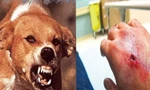Chủ nhà tử vong sau 3 tháng bị chó cắn vào cổ tay