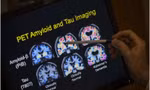 Ai nên xét nghiệm máu để phát hiện sớm bệnh mất trí nhớ Alzheimer?