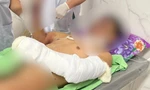 Bé trai 12 tuổi ở Đắk Lắk dập nát 2 bàn tay do pháo nổ