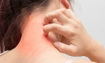 Ngứa da điên cuồng, có thể bạn đã mắc phải một trong các 'bệnh trọng' sau