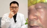 Người đàn ông ở Trung Quốc mặt sưng phù vì nhiễm khuẩn do thói quen ngoáy mũi