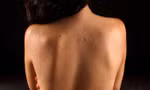 Bác sĩ chỉ cách điều trị mụn trứng cá ở lưng 
