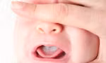 Cách xử trí khi trẻ bị bệnh nấm miệng 